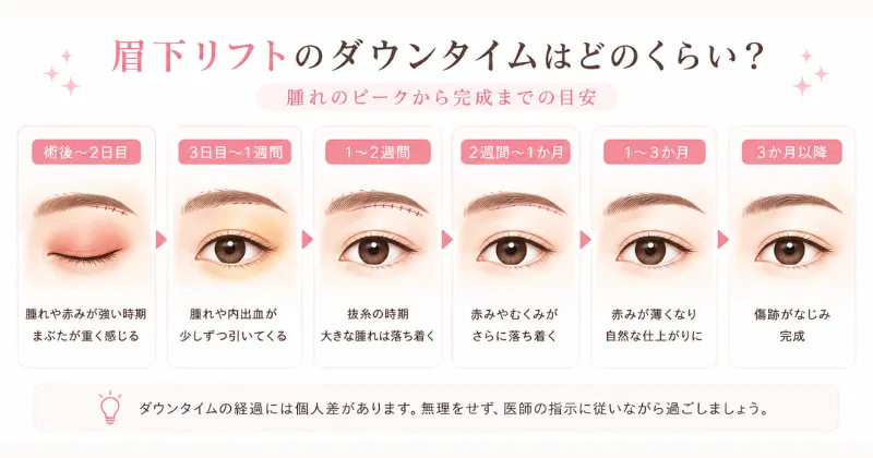 眉下リフトのダウンタイムはどのくらい?腫れのピークから完成まで