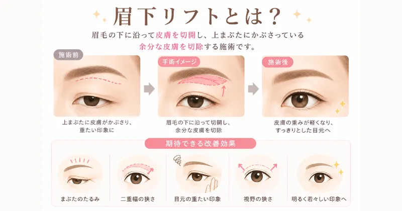 眉下リフト(眉下切開)とは?効果と仕組みを解説