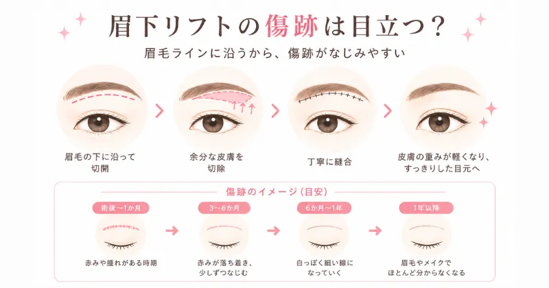 眉下リフトの傷跡は目立つ?眉毛ラインに沿う理由