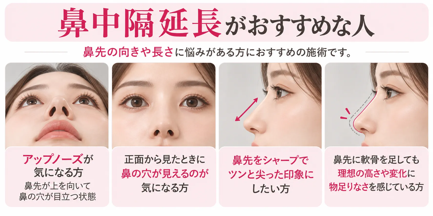 鼻中隔延長がおすすめな人:アップノーズや正面から見える鼻の穴が気になる方、鼻先をシャープにしたい方、鼻先への軟骨移植だけでは高さや変化に物足りなさを感じる方