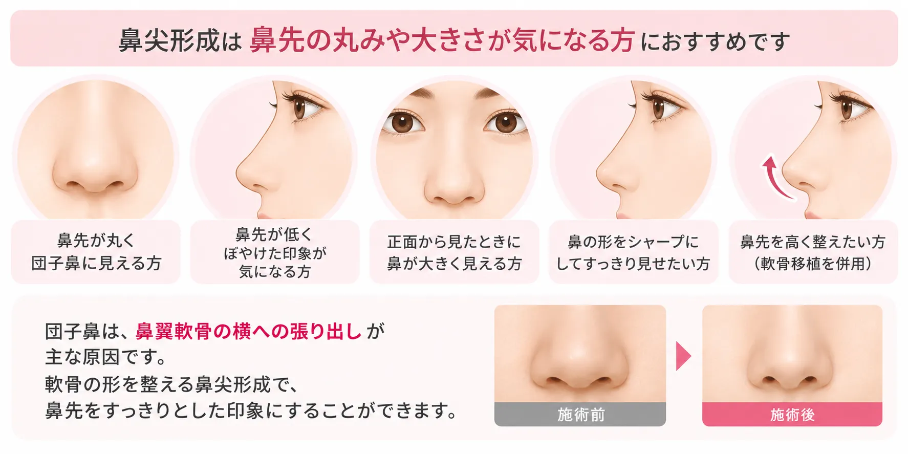 鼻尖形成がおすすめな人:鼻先の丸みや大きさ、低さが気になる方、鼻の形をシャープにしたい方、軟骨移植を併用して鼻先を高く整えたい方