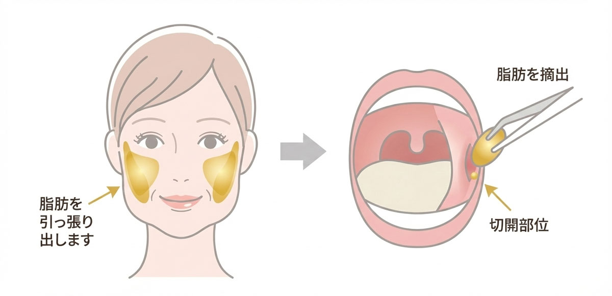 バッカルファット除去施術イメージ