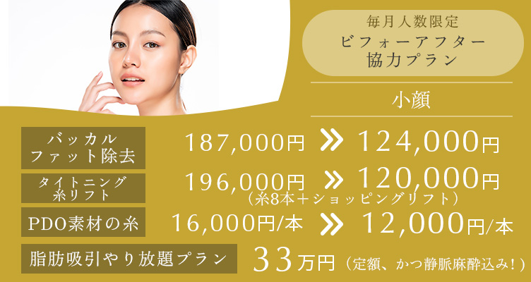 毎月人数限定 ビフォーアフター協力プラン。バッカルファット除去 187,000円→124,000円 タイトニング糸リフト（糸8本＋ショッピングリフト） 196,000円→120,000円 PDO素材の糸 16,000円/本→12,000円/本 脂肪吸引やり放題プラン 33万円 定額、かつ静脈麻酔込み！ ※全てモニター価格