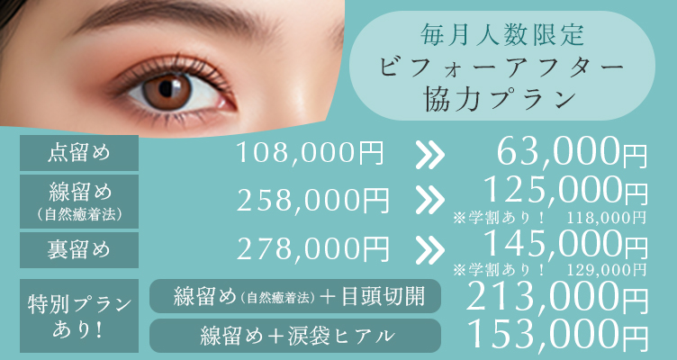 毎月人数限定 ビフォーアフター協力プラン。線留め＋涙袋ヒアル→153,000円 点留め98,000円→63,000円 線留め（自然癒着法）258,000円→125,000円 ※学割あり118.000円 裏留め278,000円→145,000円camp_bna06_250415 ※学割あり129.000円 特別プランあり　線止め＋目頭切開 213,000円