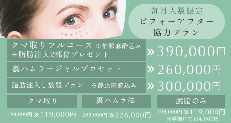 毎月人数限定 ビフォーアフター協力プラン。クマ取りフルコース＋脂肪注入2部位プレゼント※静脈麻酔込み 390,000円 裏ハムラ+ジャルプロセット260,000円 脂肪注入し放題プラン※静脈麻酔込み 300,000円 クマ取り 198,000円→119,000円 裏ハムラ法 298,000円→228,000円 脱脂のみ 198,000円→119,000円※学割にて114,000円