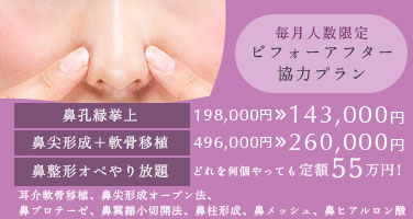 毎月人数限定 ビフォーアフター協力プラン。鼻孔縁挙上198,000円→143,000円 軟骨移植＋鼻尖形成496,000円→260,000円 鼻整形オペやり放題定額55万円　耳介軟骨移植、鼻尖形成オープン法、鼻プロテーゼ、鼻翼縮小切開法、鼻柱形成、鼻メッシュ、鼻ヒアルロン酸
