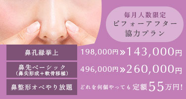 毎月人数限定 ビフォーアフター協力プラン。鼻孔縁挙上198,000円→143,000円 鼻先ベーシック(軟骨移植＋鼻尖形成)496,000円→260,000円 鼻整形オペやり放題定額55万円