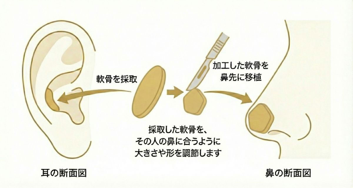 軟骨移植施術イメージ