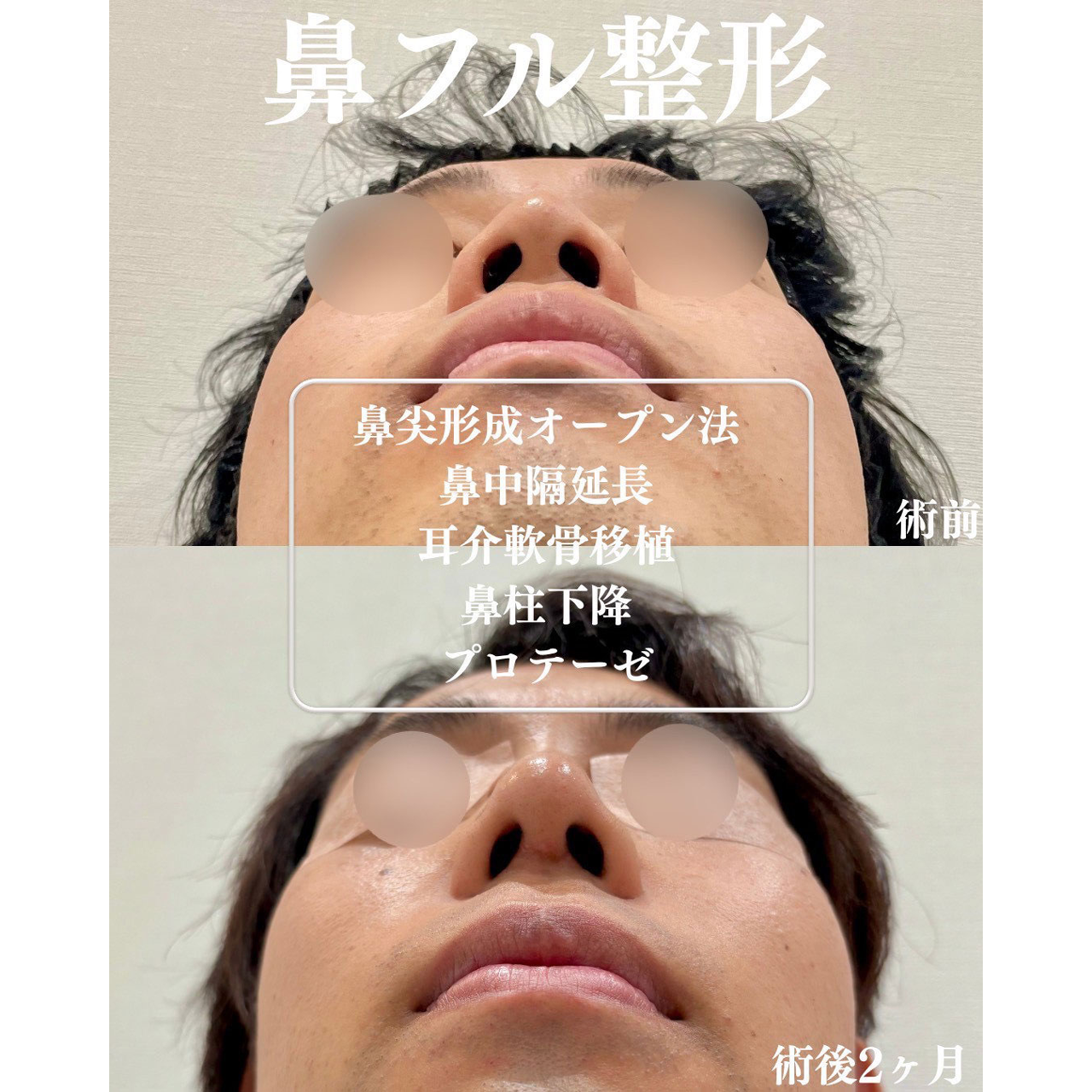鼻尖形成+鼻中隔延長+軟骨移植+鼻柱下降+プロテーゼの症例