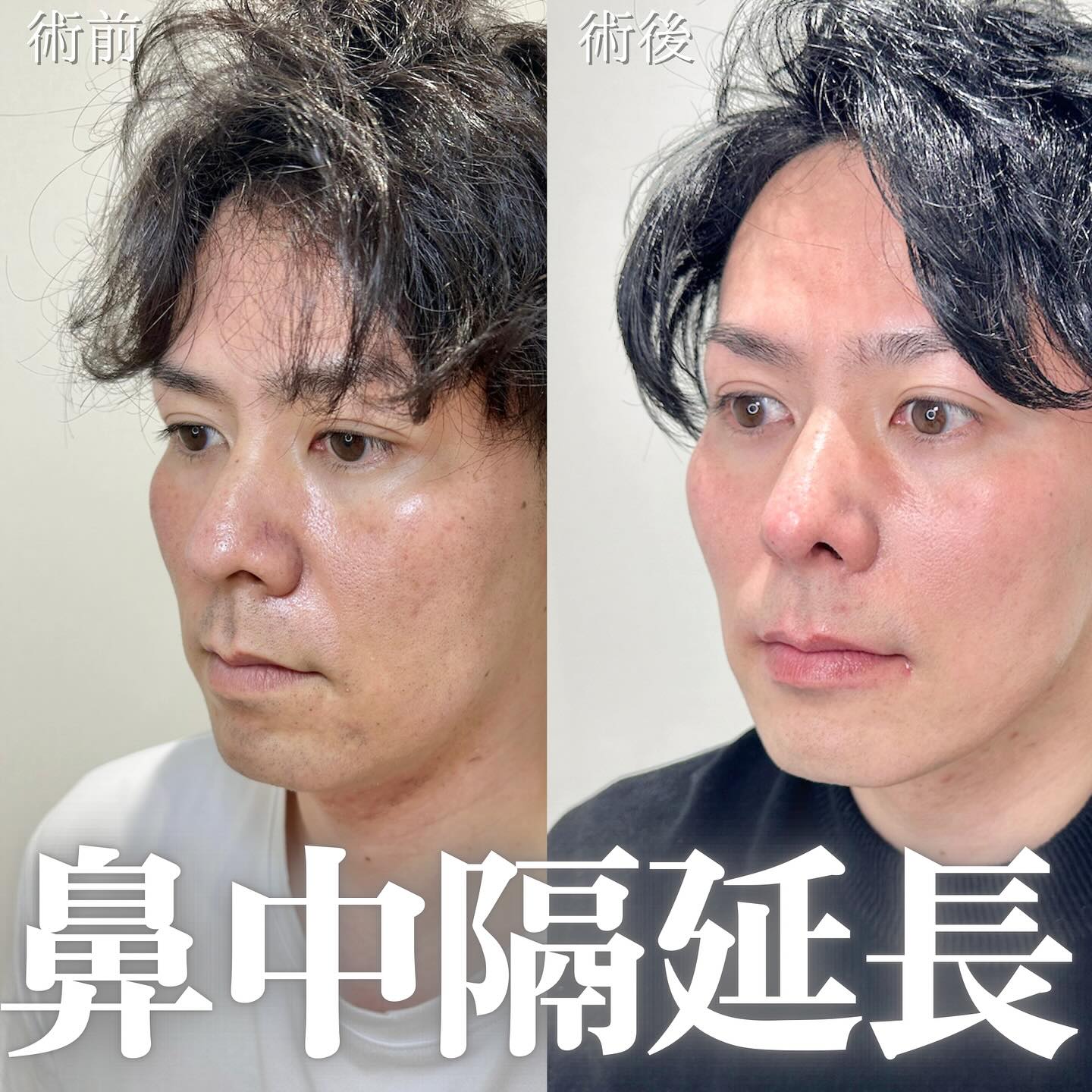 鼻中隔延長+耳介軟骨移植+小鼻縮小(内外側法)+鼻柱形成+鼻尖形成(オープン法)の症例