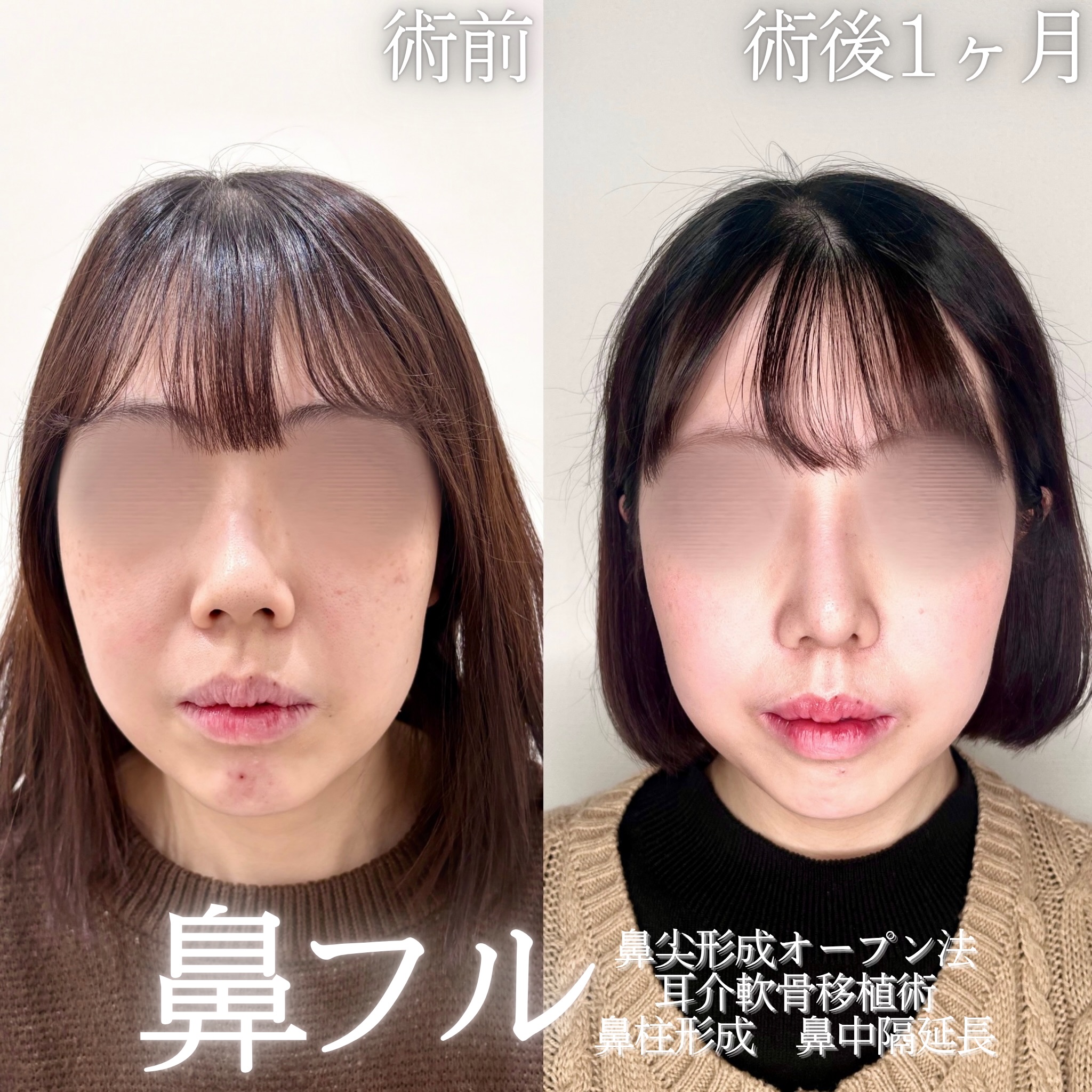 鼻尖形成(オープン法)+耳介軟骨移植+鼻柱形成+鼻中隔延長の症例