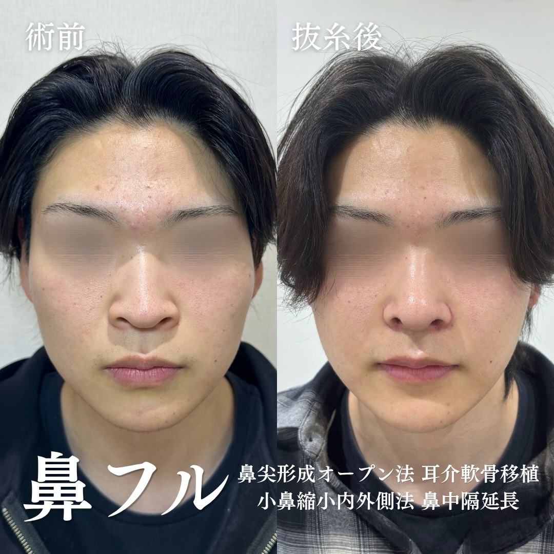 鼻尖形成(オープン法)+耳介軟骨移植+小鼻縮小(内外側法)+鼻中隔延長+鼻筋プロテーゼの症例