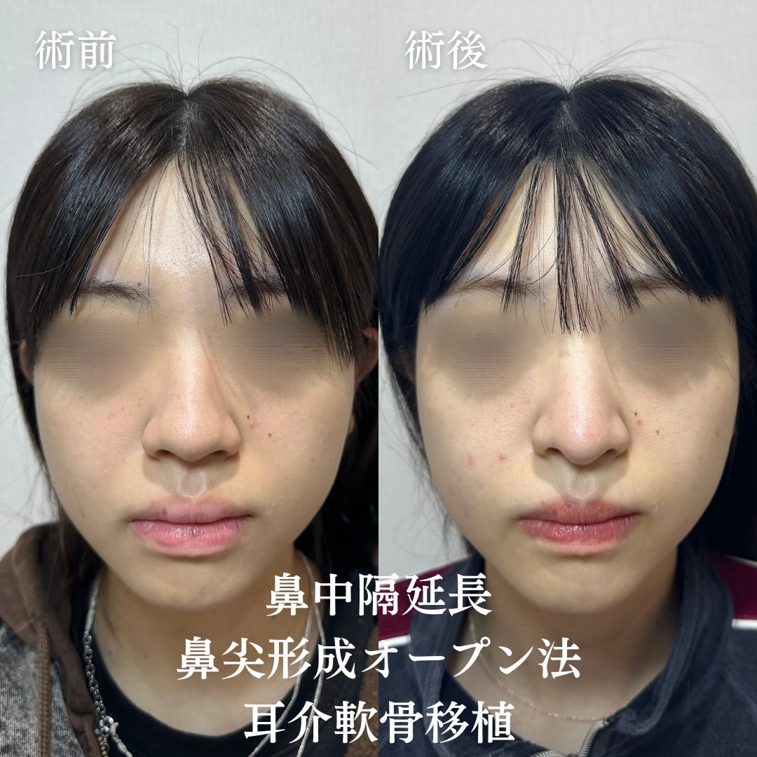 鼻中隔延長+鼻尖形成(オープン法)+耳介軟骨移植の症例