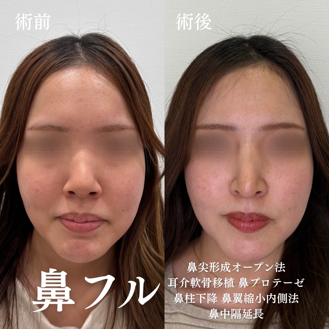 鼻尖形成(オープン法)+耳介軟骨移植+鼻プロテーゼ+鼻柱下降+小鼻縮小(内外側法)+鼻中隔延長の症例