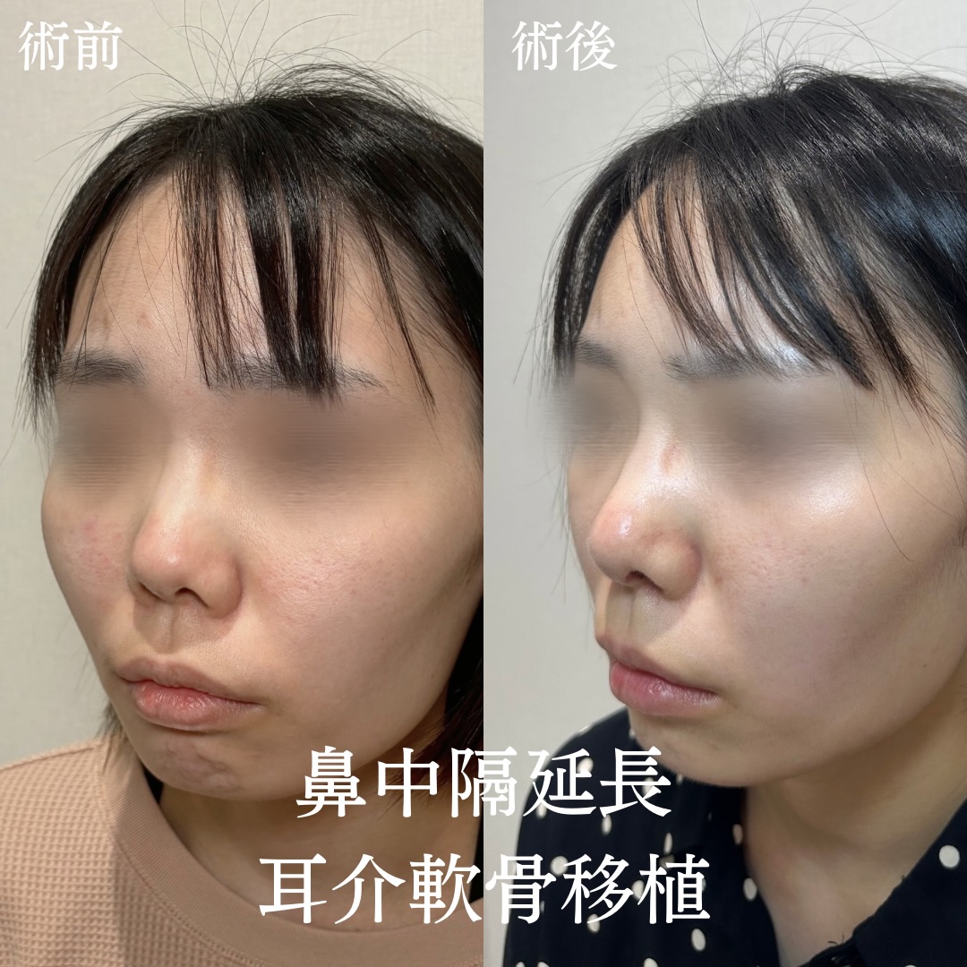 鼻中隔延長+耳介軟骨移植の症例