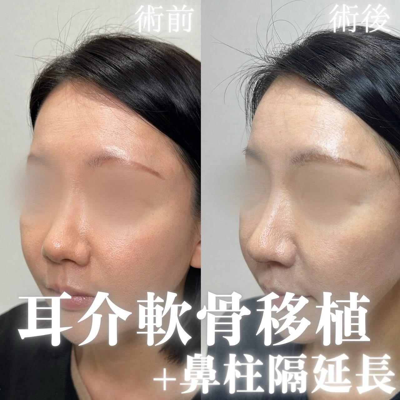 耳介軟骨移植+鼻尖形成(オープン法)+鼻中隔延長の症例
