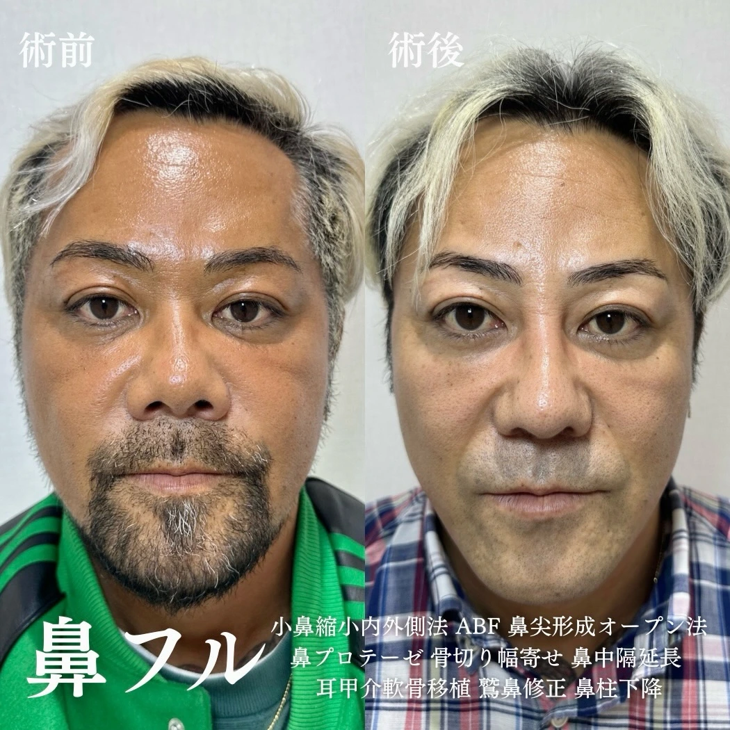 鼻尖形成(オープン法)+耳甲介軟骨移植+鷲鼻修正+鼻柱下降+鼻中隔延長+小鼻縮小(内外側法)+鼻筋プロテーゼ+鼻骨骨切り幅寄せ+小鼻縮小(ABF法)の症例