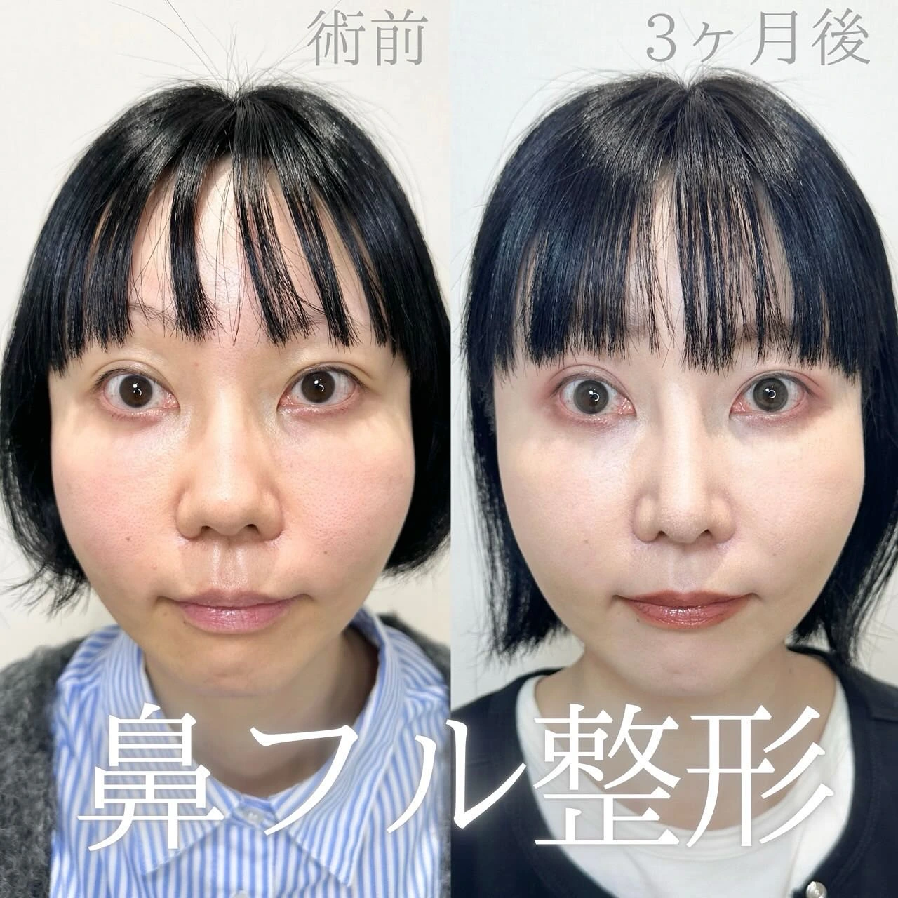 鼻尖形成(オープン法)+耳介軟骨移植+鼻柱下降+鼻中隔延長+鼻筋プロテーゼの症例