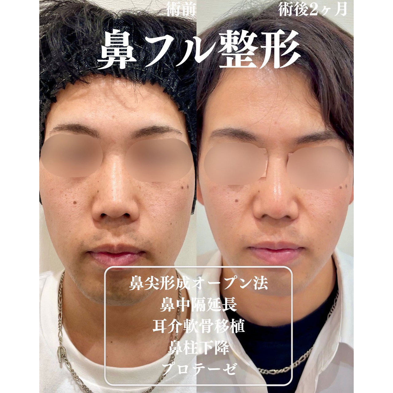 鼻尖形成+鼻中隔延長+軟骨移植+鼻柱下降+プロテーゼの症例