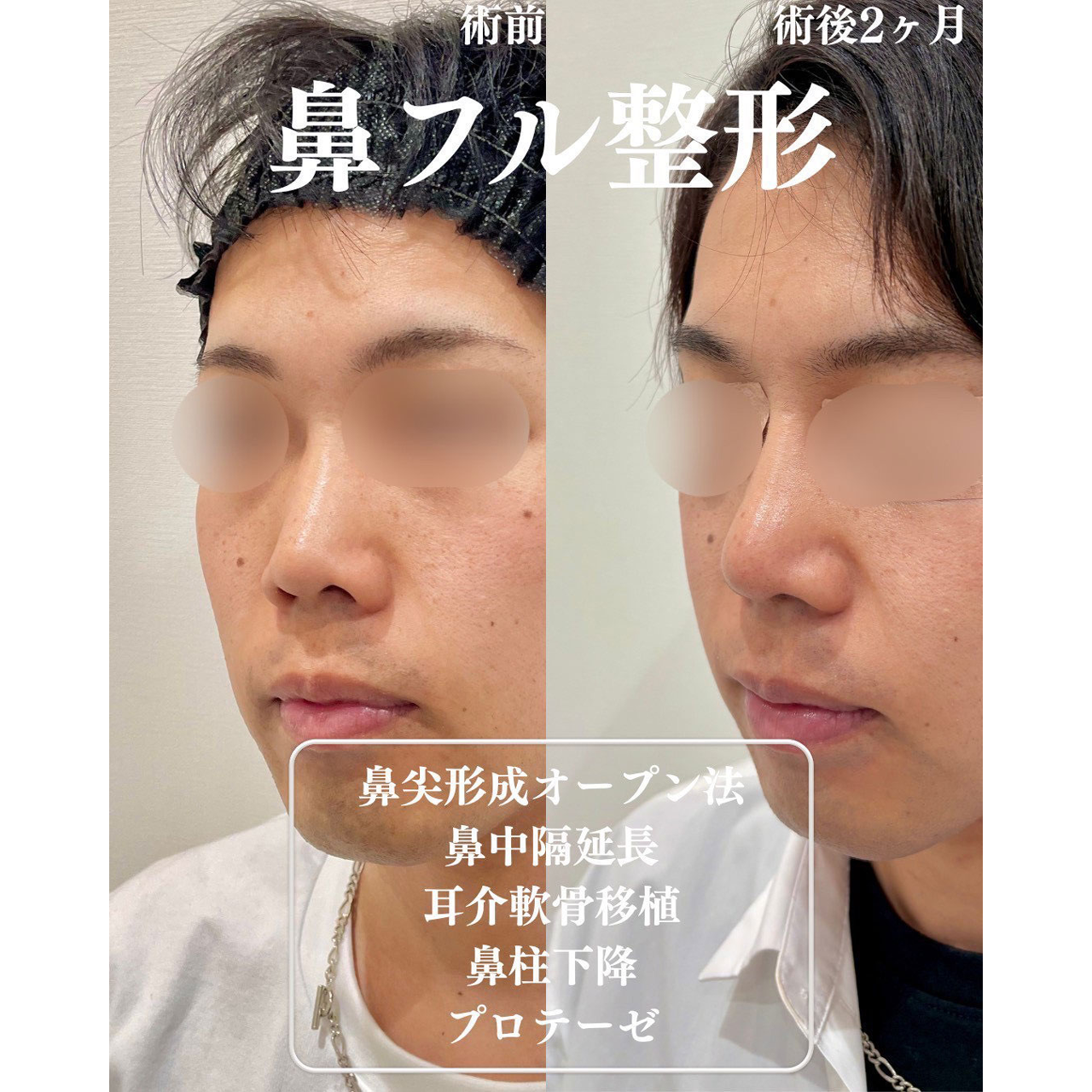 鼻尖形成+鼻中隔延長+軟骨移植+鼻柱下降+プロテーゼの症例