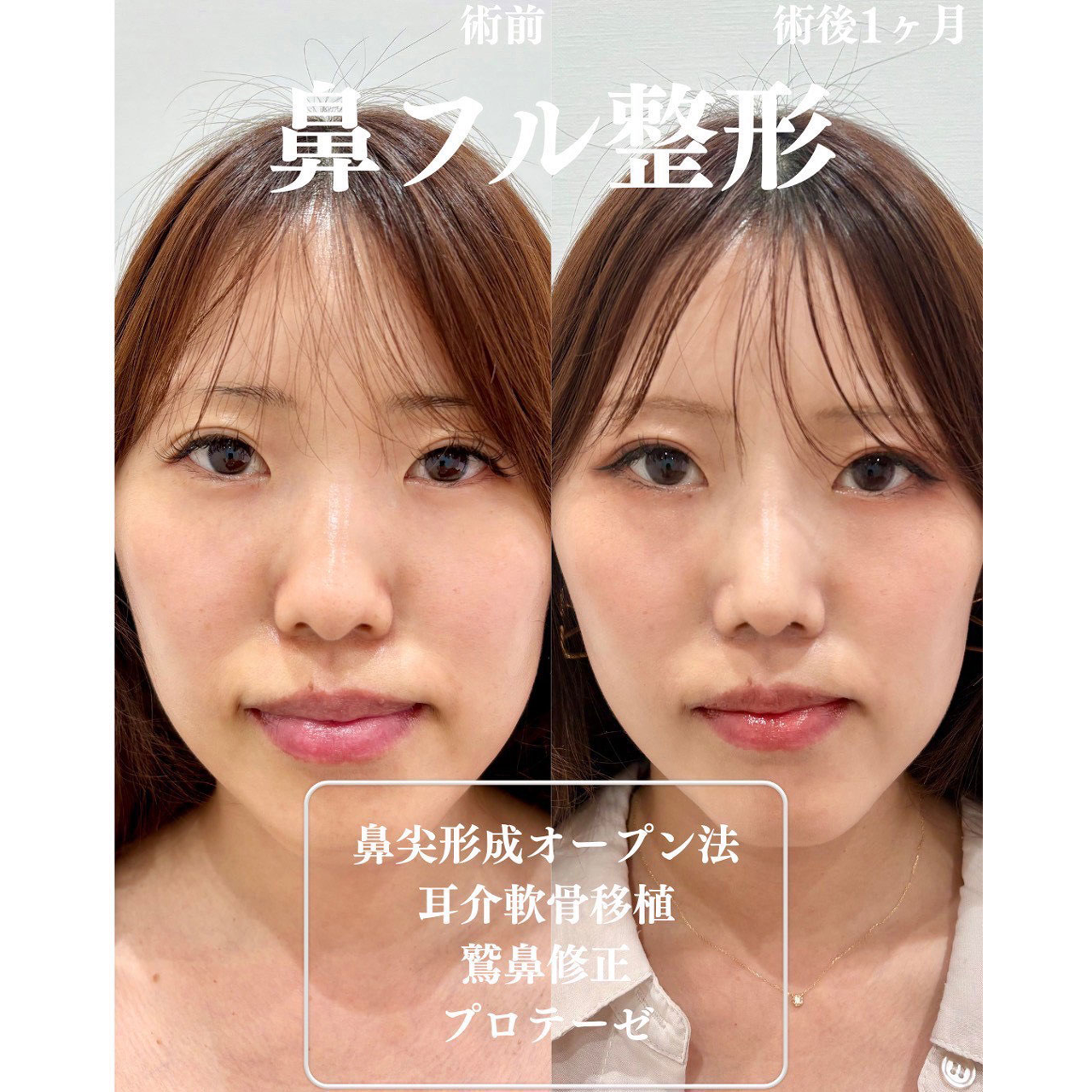 鼻尖形成+軟骨移植+鷲鼻修正+プロテーゼの症例