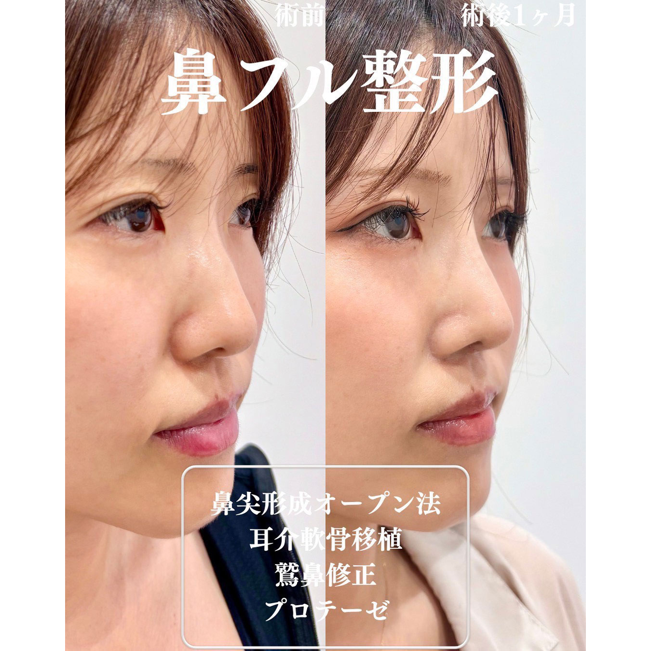 鼻尖形成+軟骨移植+鷲鼻修正+プロテーゼの症例