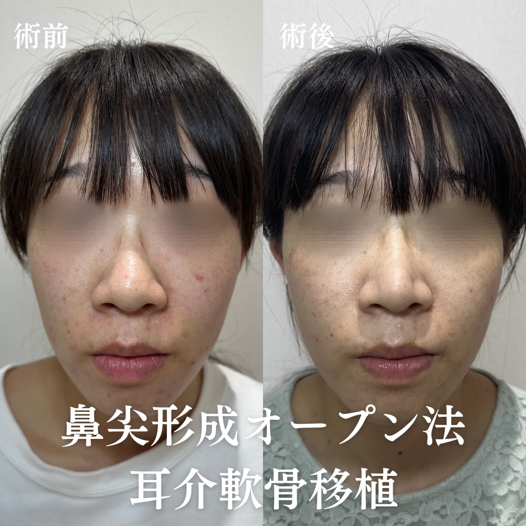 鼻尖形成(オープン法)+耳介軟骨移植の症例