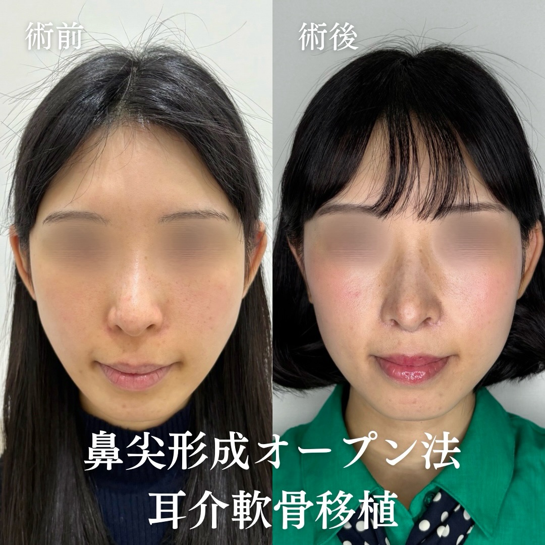 鼻尖形成(オープン法)+耳介軟骨移植の症例