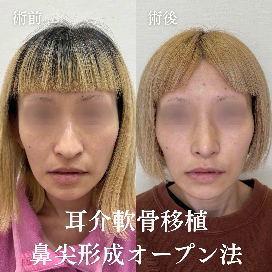 鼻尖形成(オープン法)+耳介軟骨移植の症例
