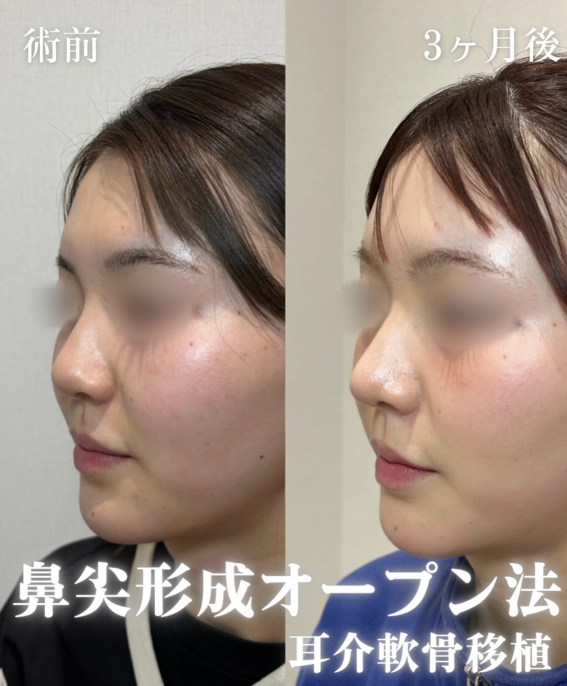 鼻尖形成(オープン法)+耳介軟骨移植の症例
