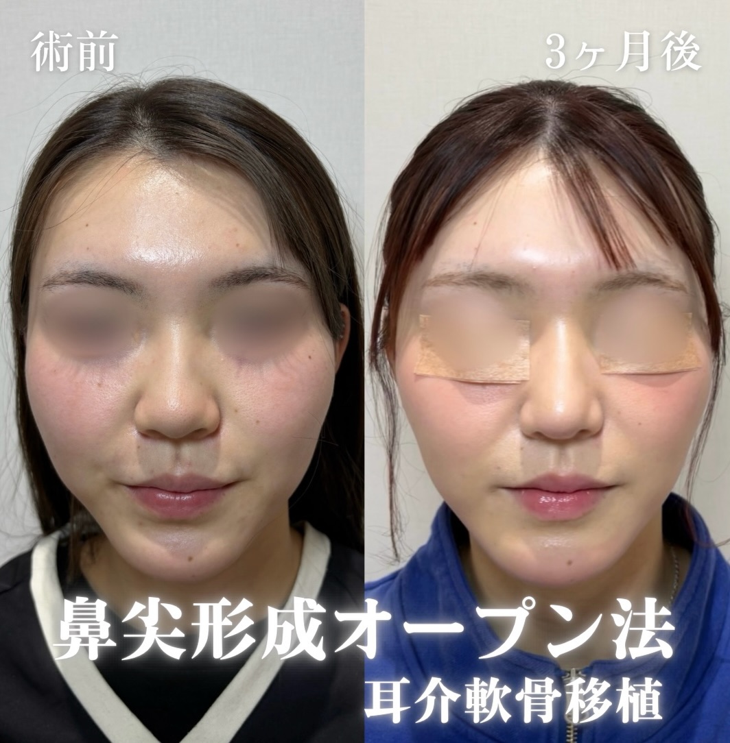 鼻尖形成(オープン法)+耳介軟骨移植の症例