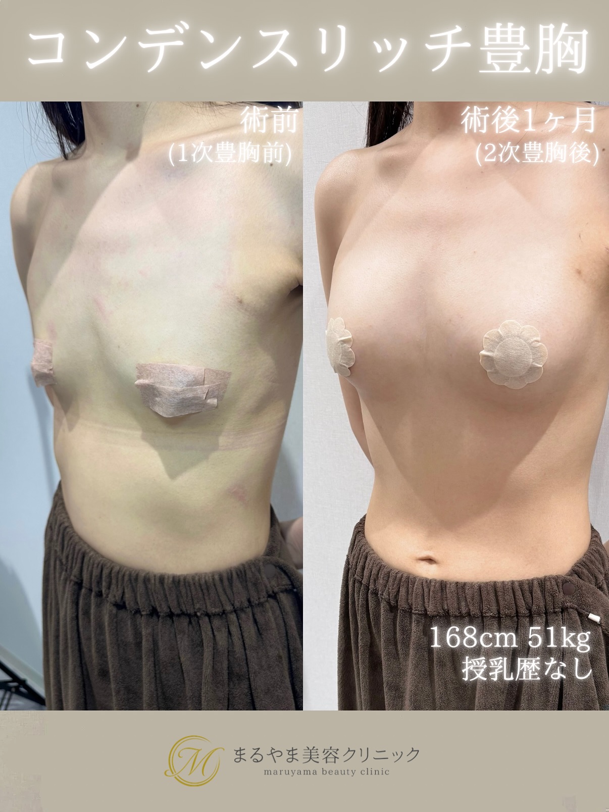 脂肪注入豊胸(コンデンスリッチ豊胸)の症例③