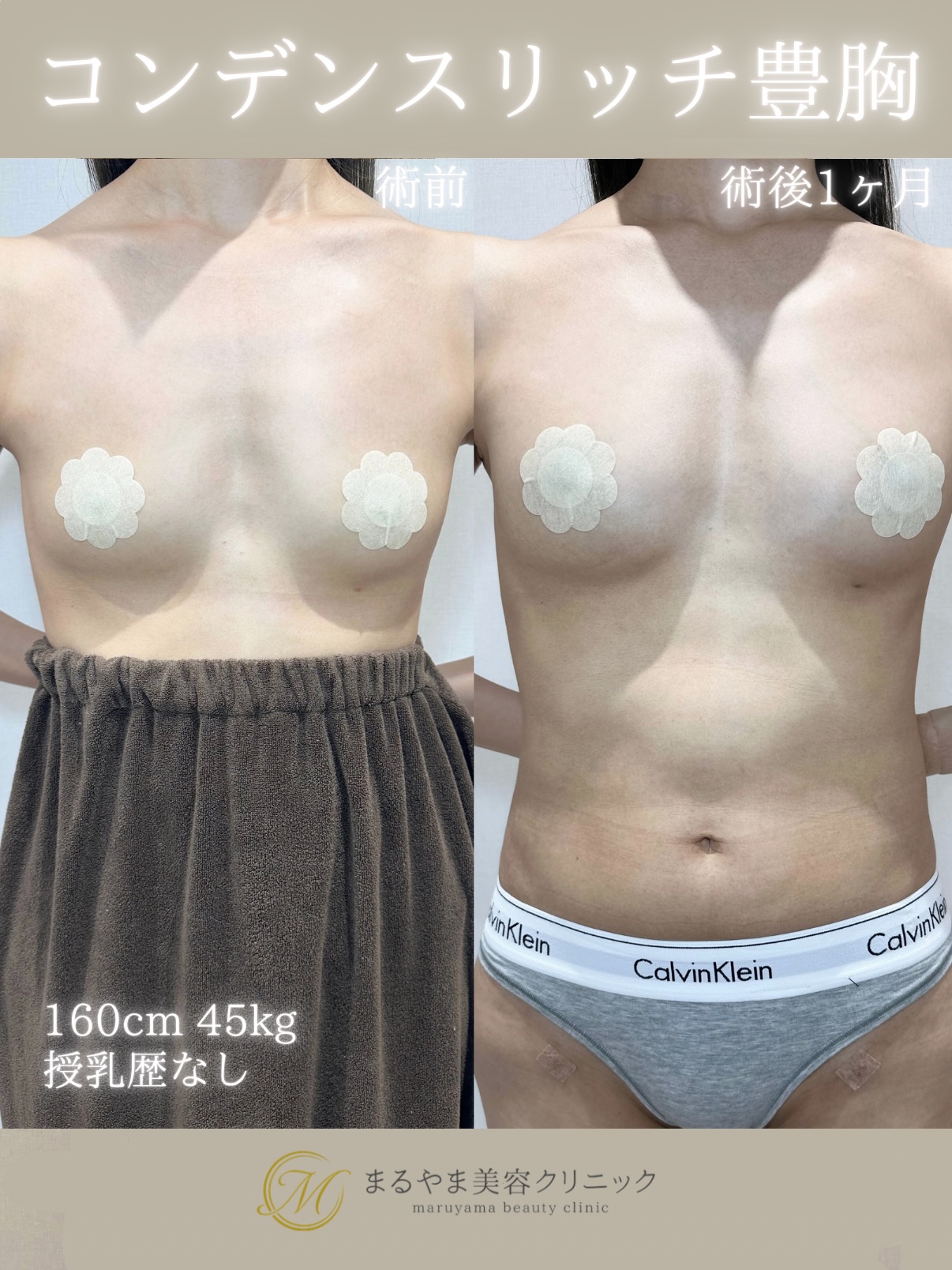 脂肪注入豊胸(コンデンスリッチ豊胸)の症例②