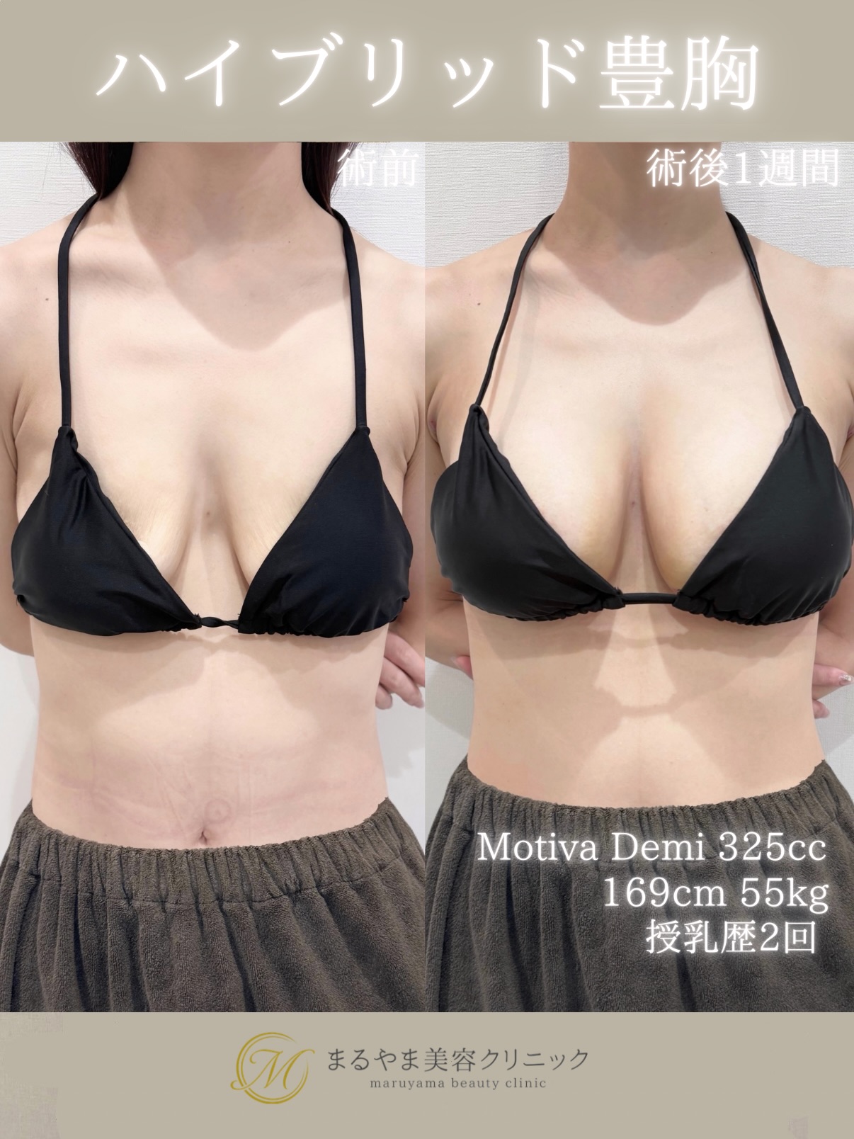 ハイブリッド豊胸の症例⑦