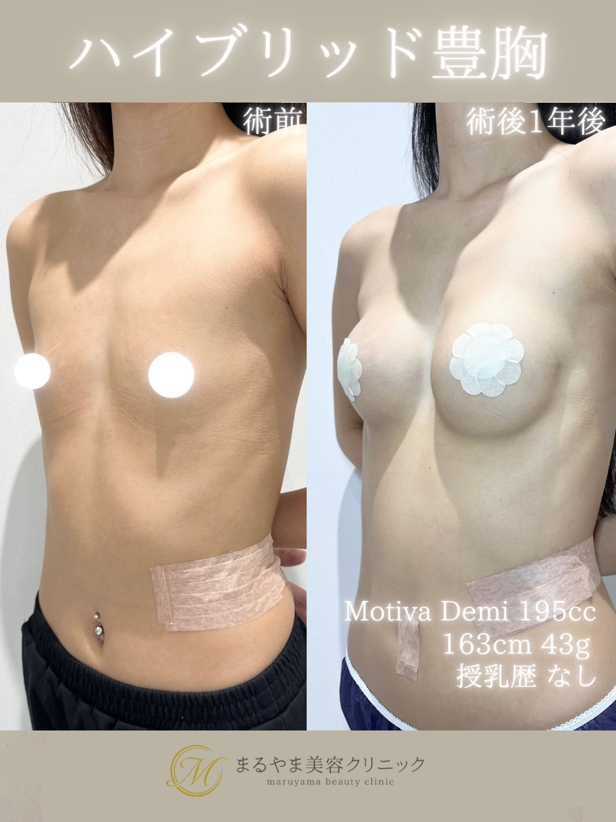 ハイブリッド豊胸の症例⑥