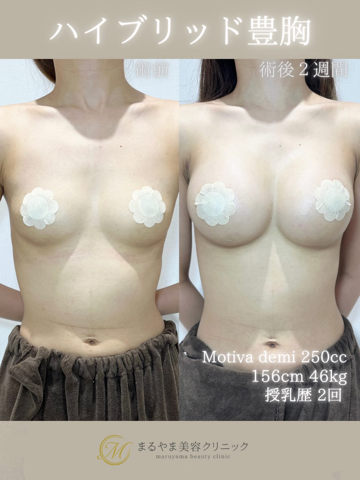 ハイブリッド豊胸の症例