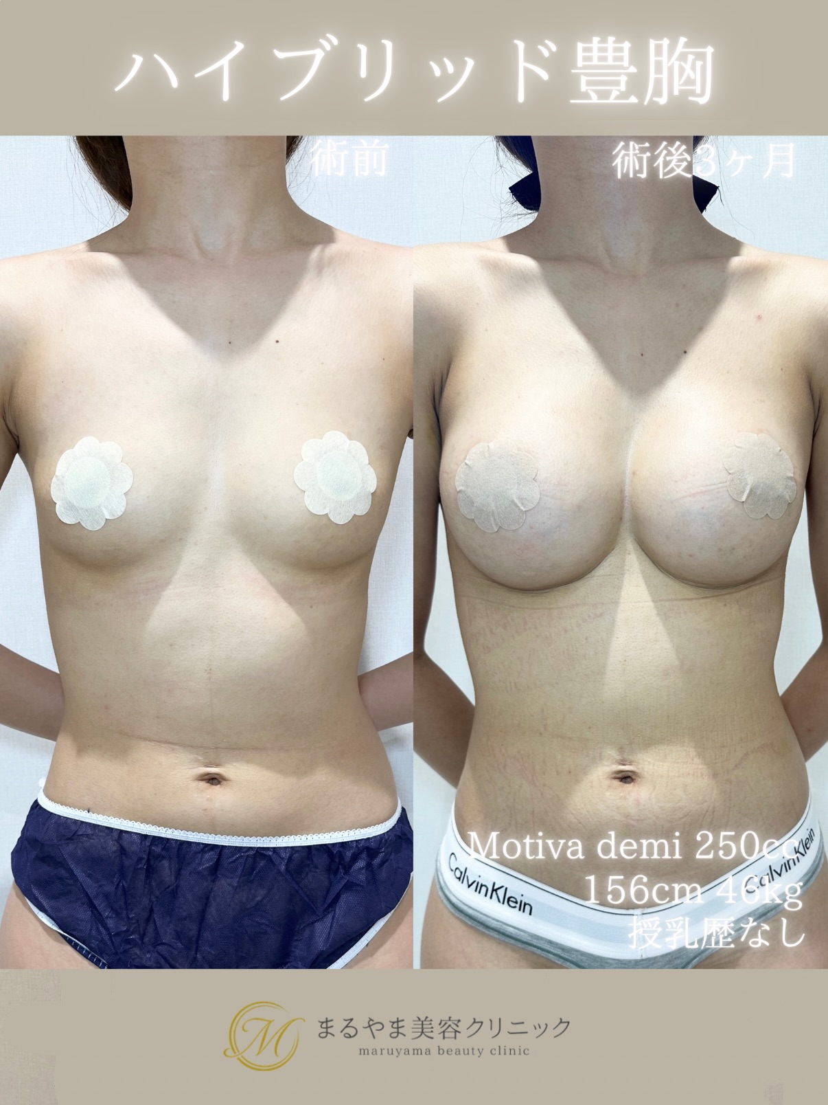 ハイブリッド豊胸の症例④
