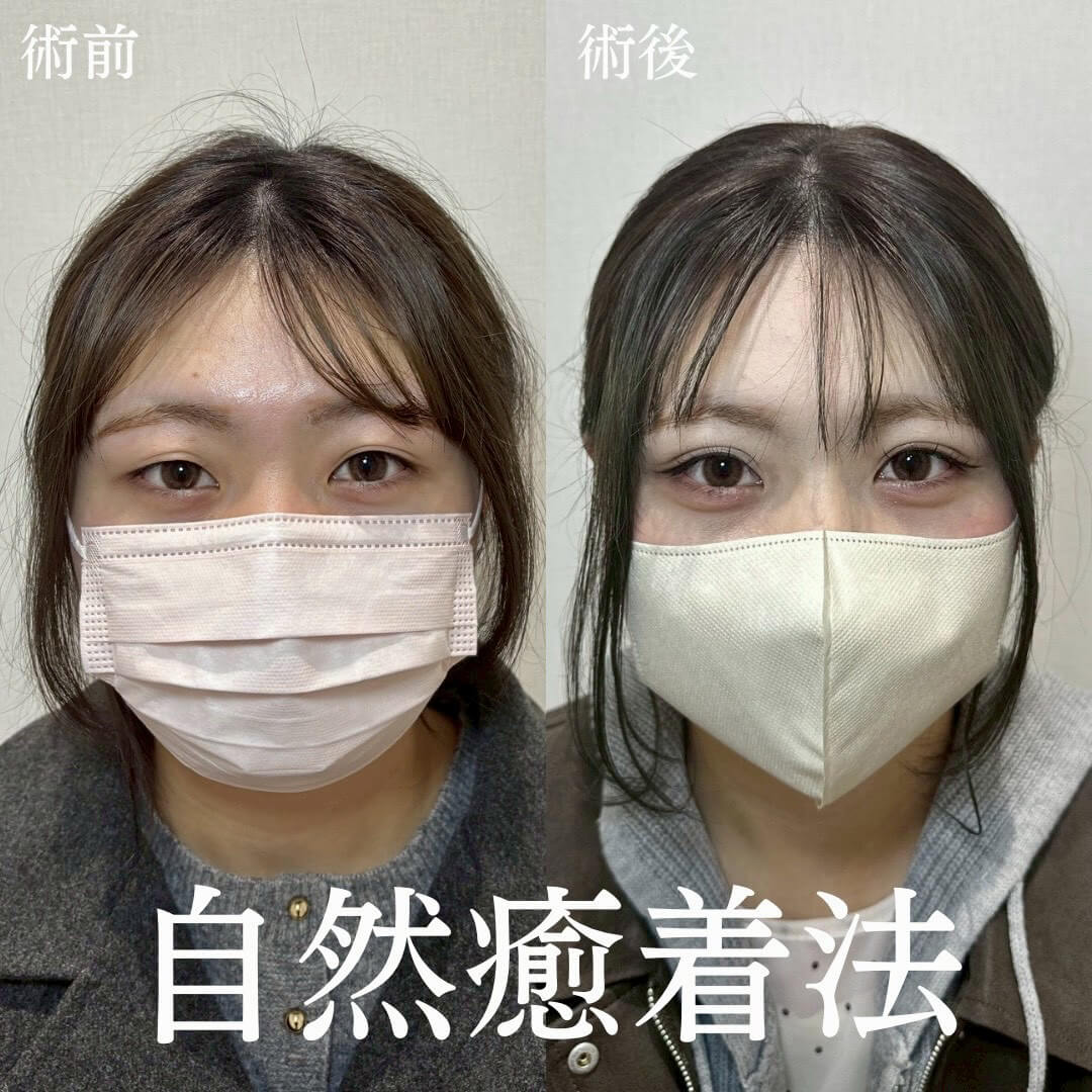 二重埋没法 症例11