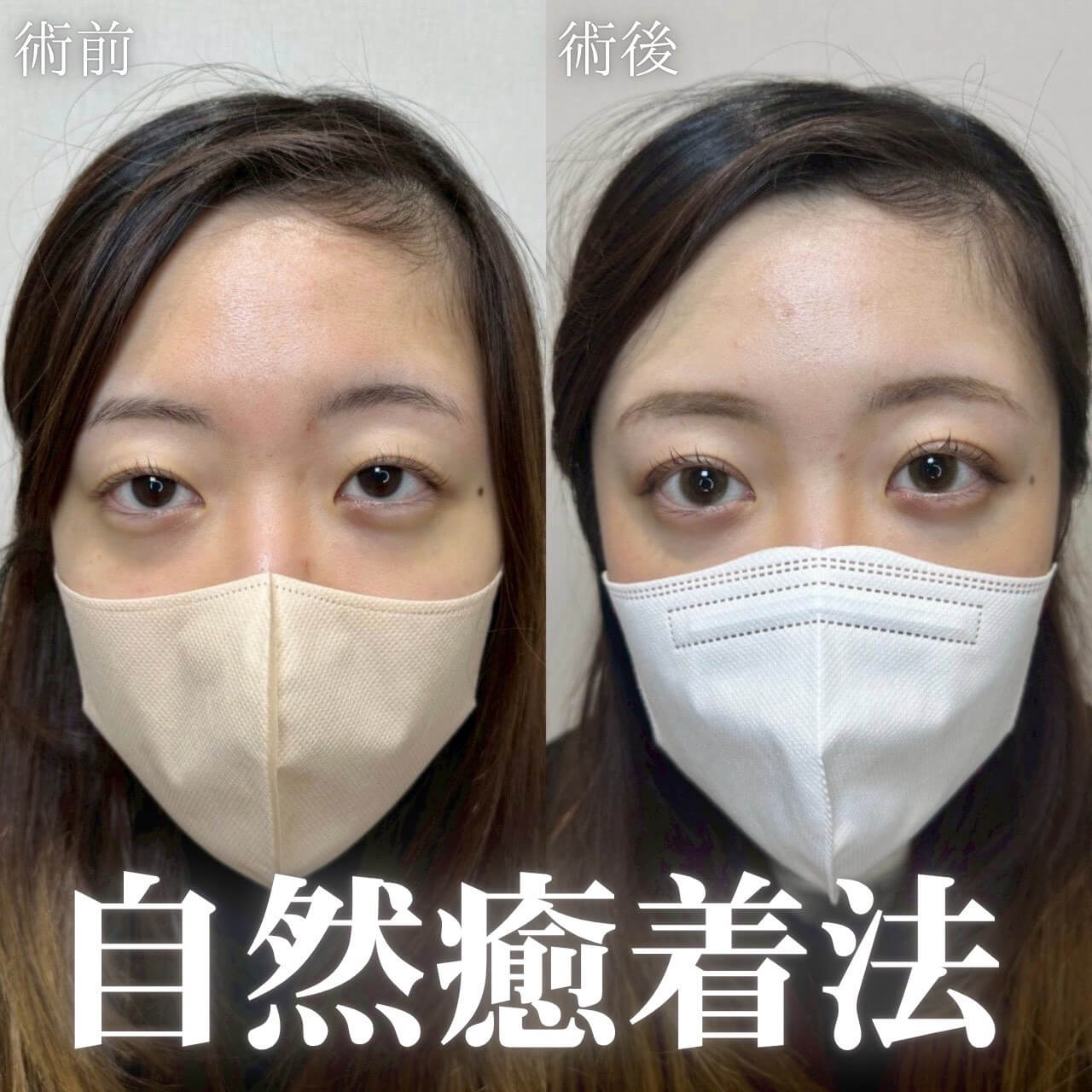 二重埋没法 症例12