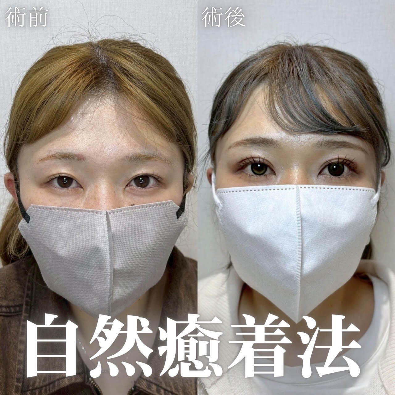 二重埋没法 症例13