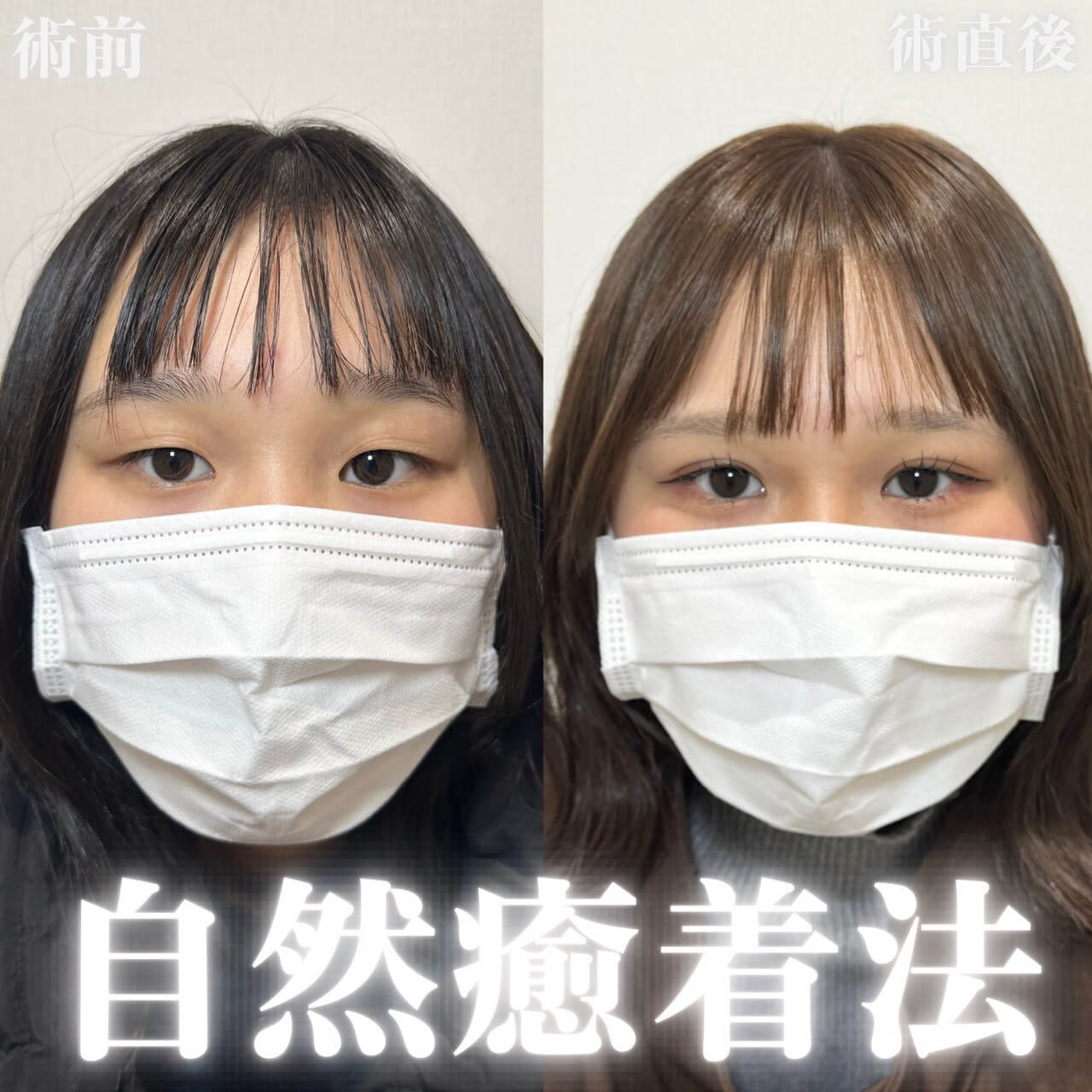 二重埋没法 症例14