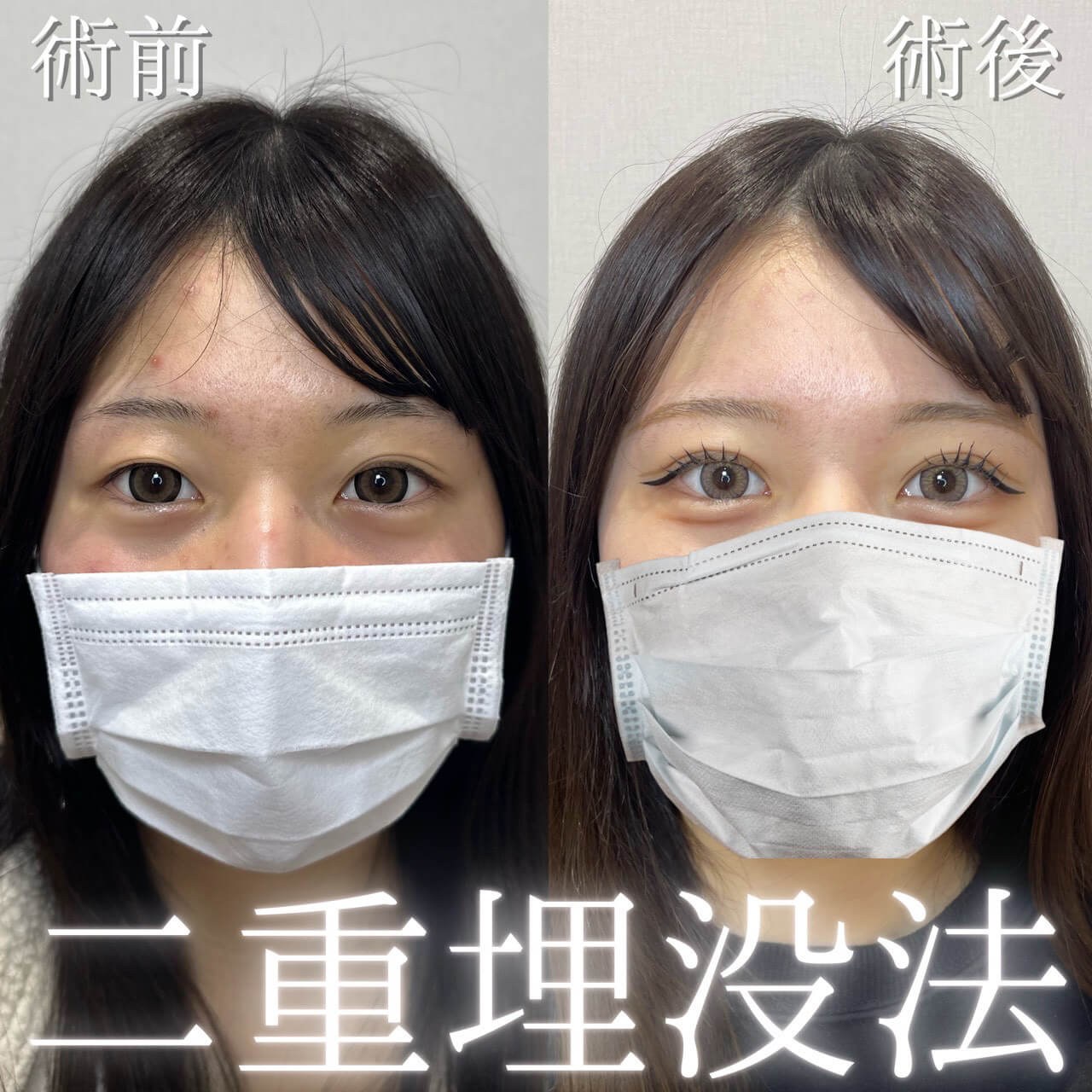 二重埋没法 症例15