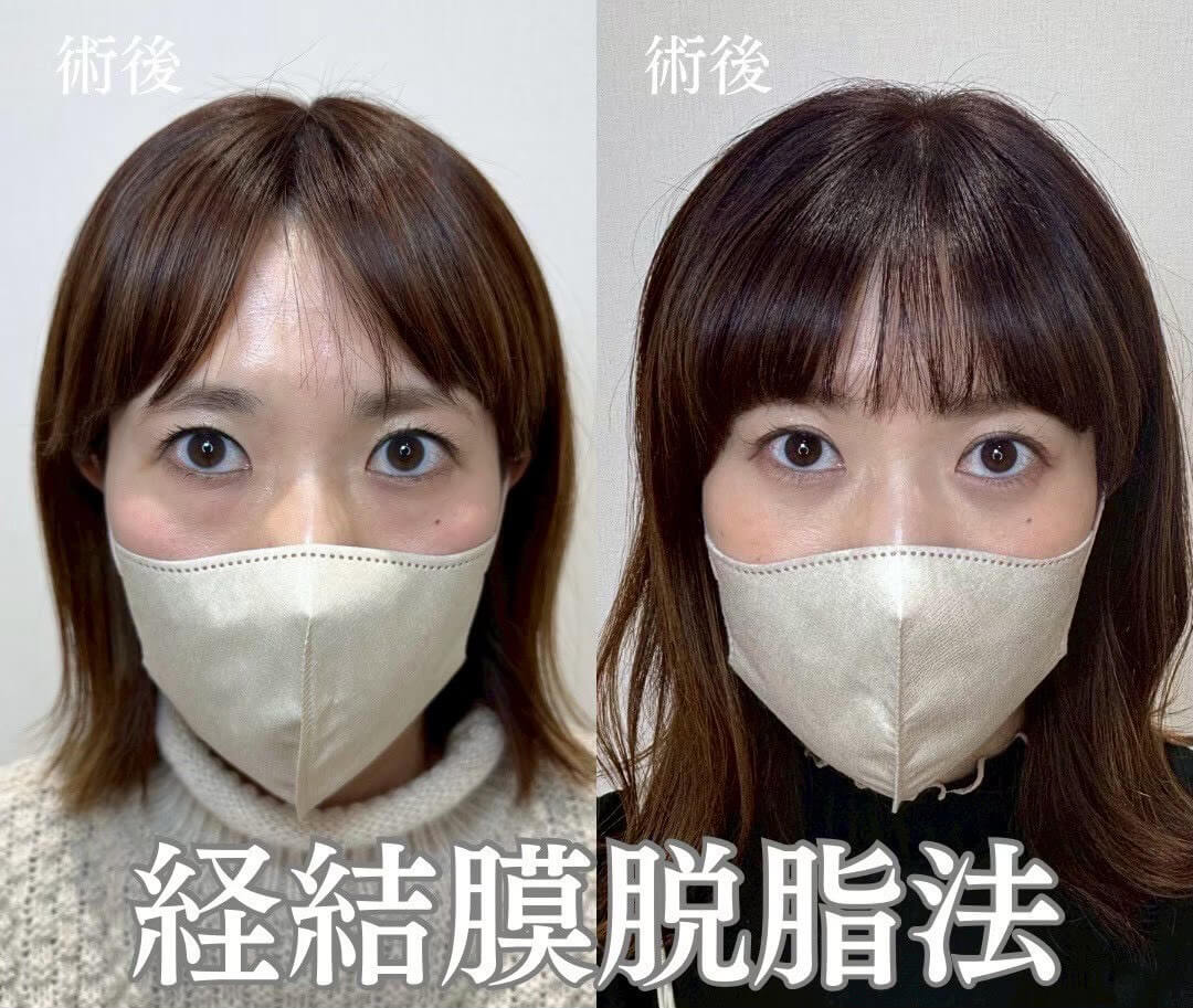 クマ取り 症例13