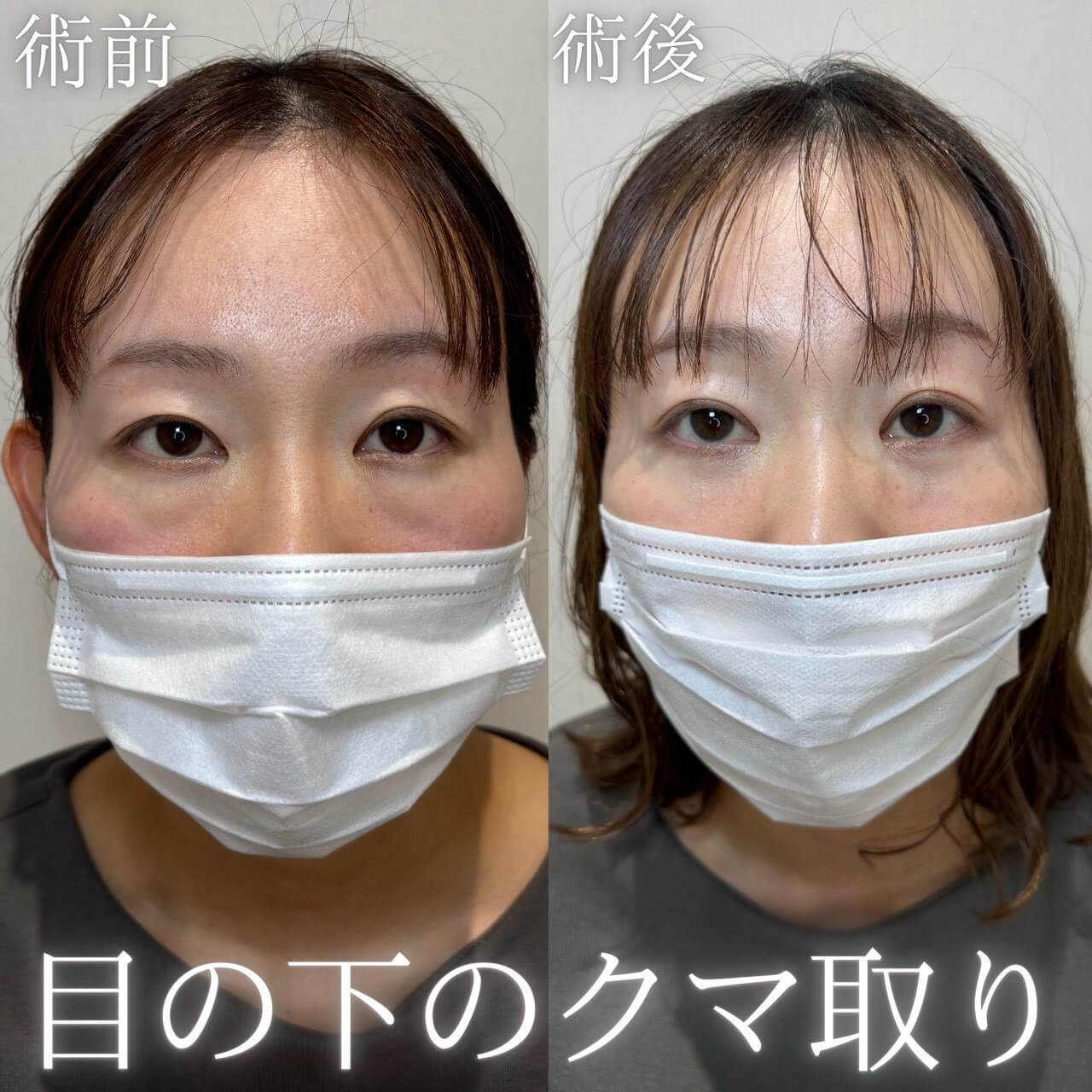 クマ取り 症例18