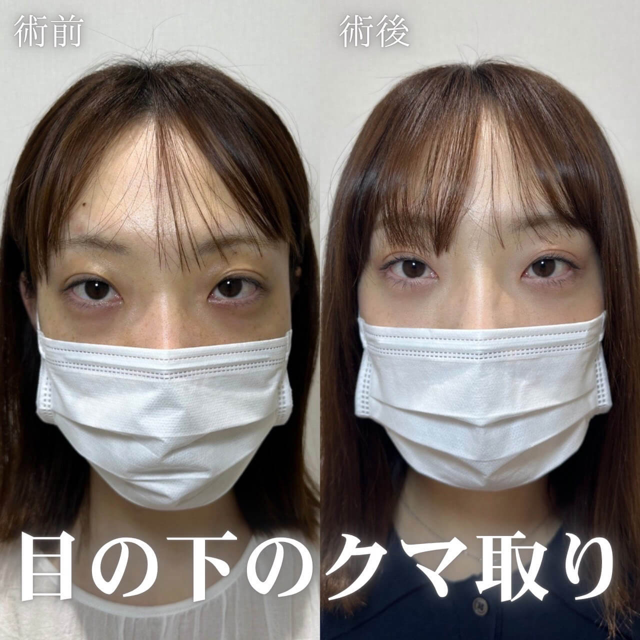 クマ取り 症例19