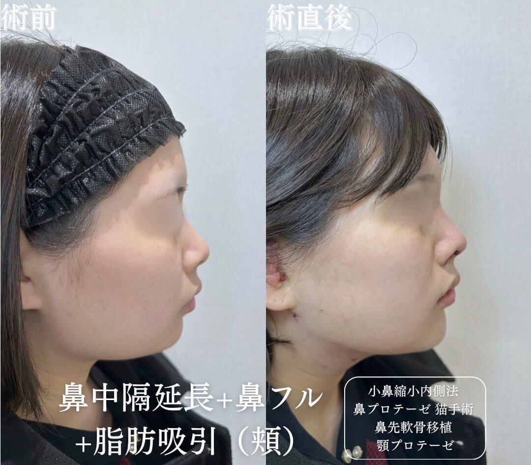 鼻整形 症例12