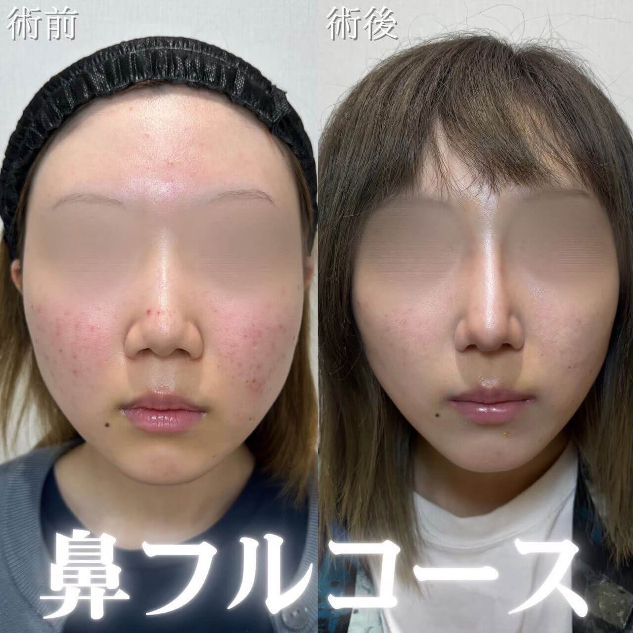 鼻整形 症例15