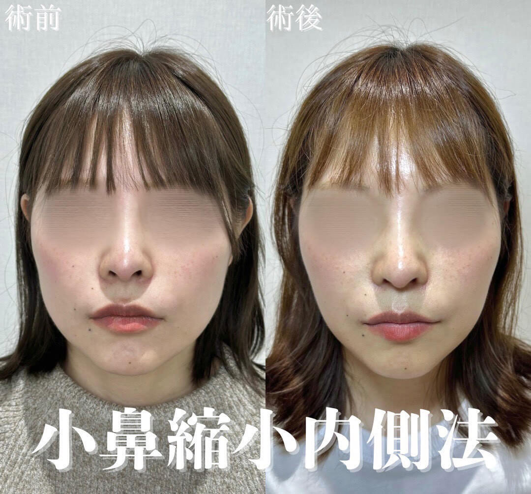鼻整形 症例22