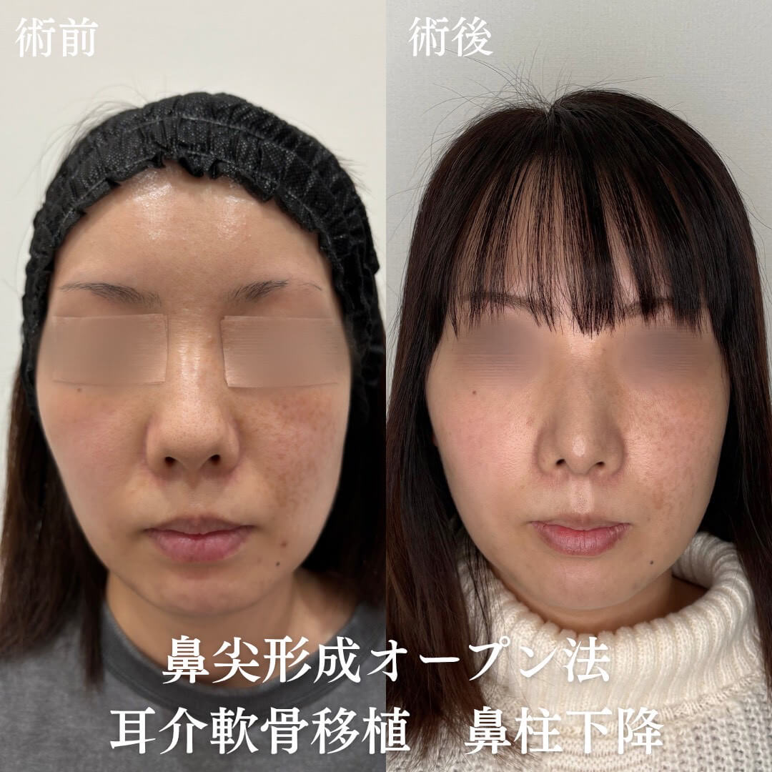 鼻整形 症例23