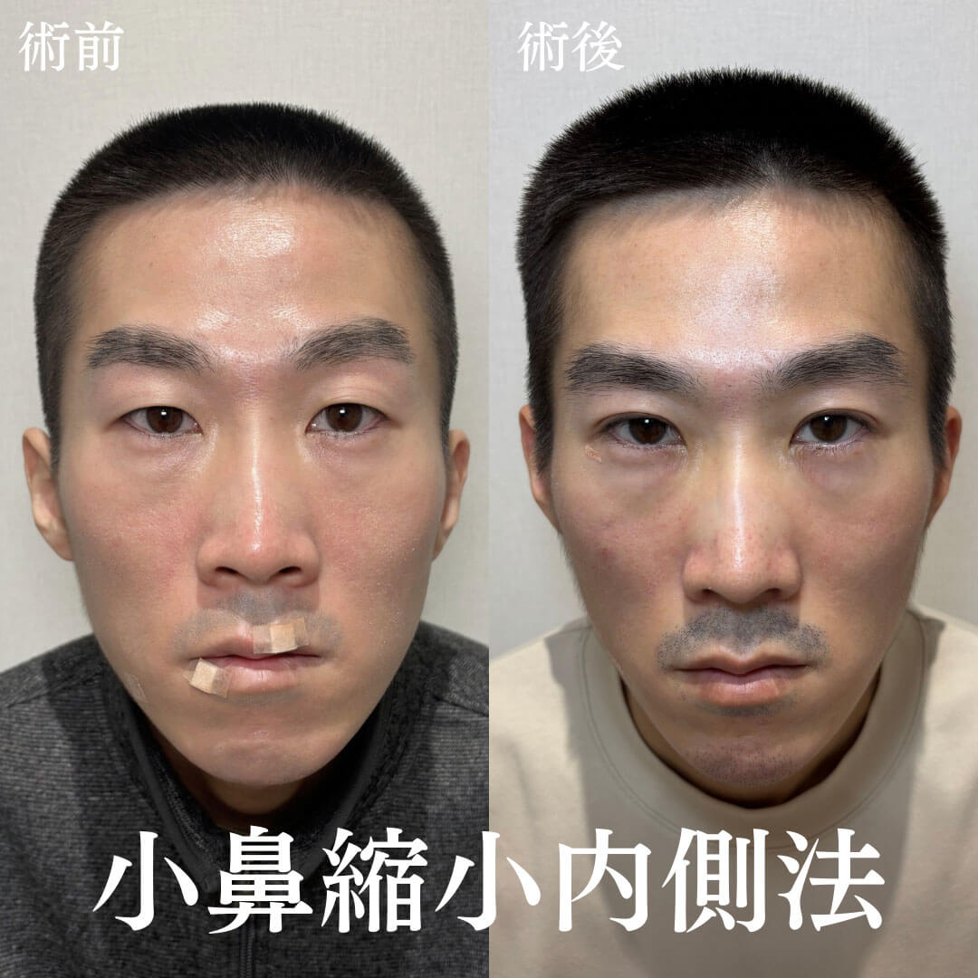 鼻整形 症例28
